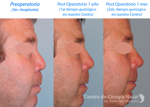 rinoplastia secundaria