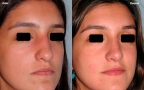 antes-despues-rinoplastia-primaria-3cuarto-caso460