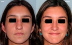 antes-despues-rinoplastia-primaria-frente-caso460