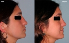 antes-despues-rinoplastia-primaria-perfil-caso460