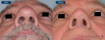 rinoplastias-antes-despues-nariz-hiper-proyectada-base