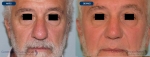 rinoplastias-antes-despues-nariz-hiper-proyectada-frente