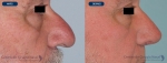 rinoplastias-antes-despues-nariz-hiper-proyectada-perfil