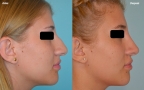 antes-despues-rinoplastia-primaria-giba-punta-bulbosa-perfil