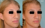 antes-despues-rinoplastia-primaria-giba-punta-bulbosa-trescuartos