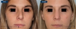 rinoplastias-antes-despues-325-frente