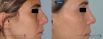 rinoplastias-antes-despues-325-perfil