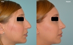 antes-despues-rinoplastia-primaria-perfil-caso425