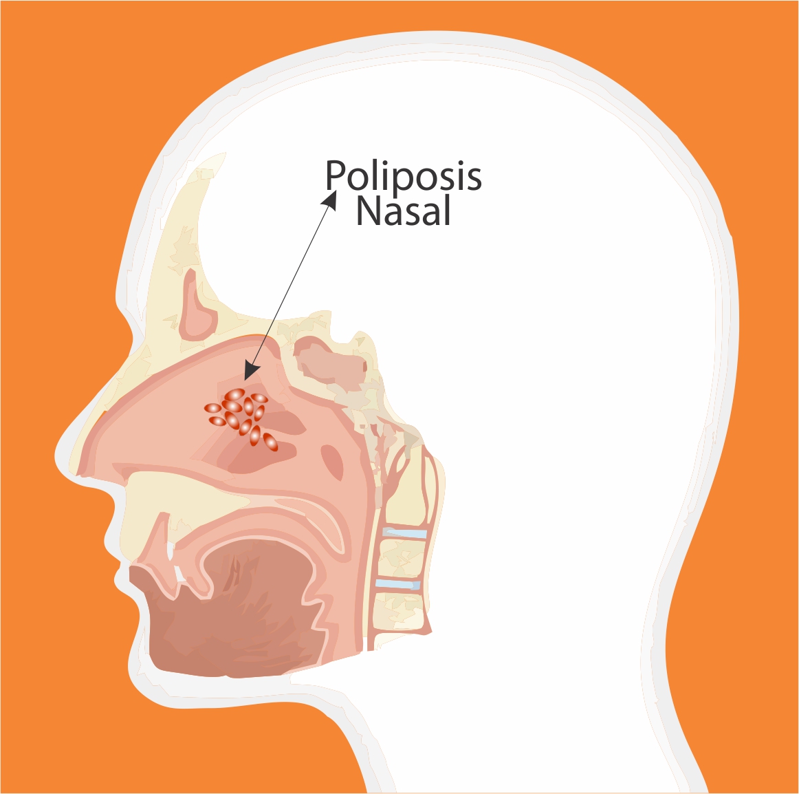 poliposis nasal