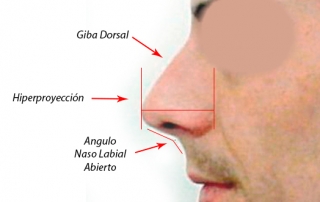 rinoplastia: detalles de giba dorsal, hiperproyección y angulo nasal